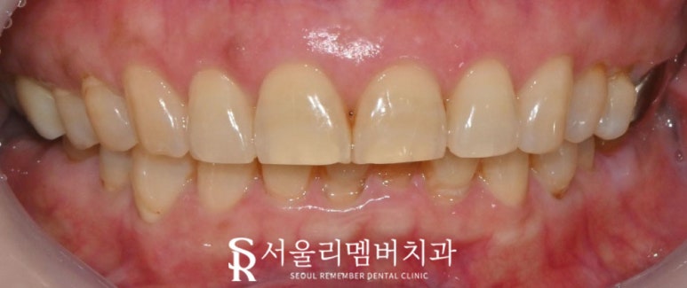 상도동 치과 심미 치료 잘하는 곳 찾는다면 관련 이미지 3