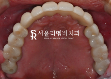 여러 곳이 결손된 치아 서울대입구역 치과 에서 다수 임플란트 식립으로 불편감을 개선해 드린 케이스 관련 이미지 6