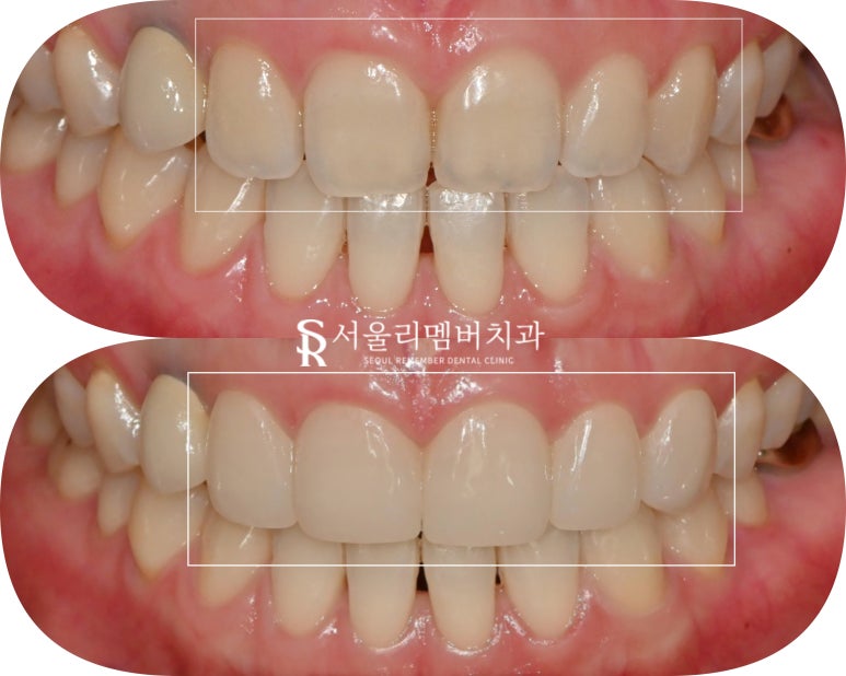 상도동 치과 "진짜(real, 리얼) 같은 자연스러움" 개인 맞춤형 무삭제 라미네이트 관련 이미지 1