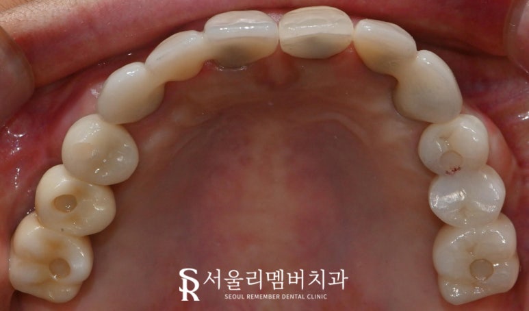 잇몸뼈 소실 다수의 치아 서울대입구역 치과 에서 전체 임플란트 브릿지 수술 진행 관련 이미지 5