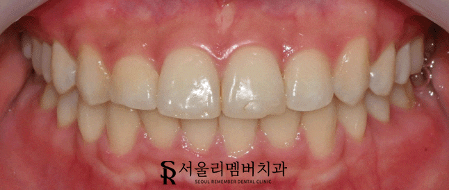 낙성대역 치과 앞니가 깨졌는데 당일 치료 가능할까요? 관련 이미지 1