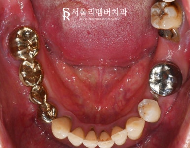 한 번에 많은 치아 치료해야 된다면? 사당역 치과 수면 임플란트 로 편안하게 관련 이미지 3