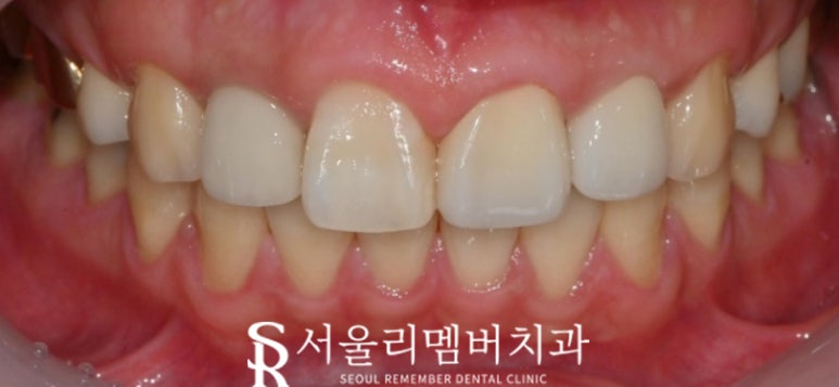 앞니 변색 이유는? 사당 치과 충치치료 로 환한 미소 되찾는 방법 관련 이미지 2