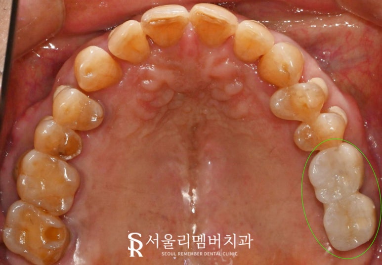 잃어버린 치아, 봉천동 치과 임플란트로 되찾는 자연스러운 미소와 건강한 저작 기능 관련 이미지 3