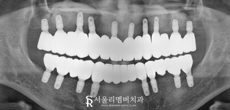 서울대입구역 치과 무너진 수직 고경 어떻게 개선했을까? 관련 이미지 7