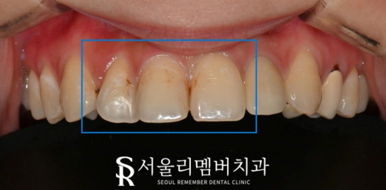 낙성대역 치과 오래된 앞니 레진 변색 및 착색되어 재치료 필요하다면? 관련 이미지 1