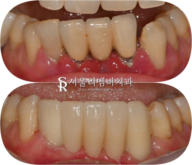 Loose Lower Front Teeth, Sillim Station Dental Clinic, Insurance Anssurge Implant for Patients 65 and Older, Minimal Placement, Lower Cost, Faster Completion image 9