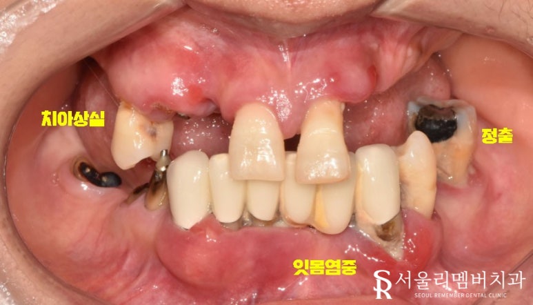금방이라도 빠져버릴 것 같은 치아들, 전체임플란트 식립으로 개선했던 이야기. 이수역 서울 리멤버 치과 관련 이미지 1