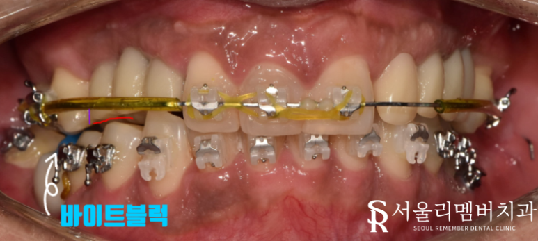 임플란트와 치아교정, 동시에 치료받을 수 있을까요? 남성역 서울 리멤버 치과 관련 이미지 7