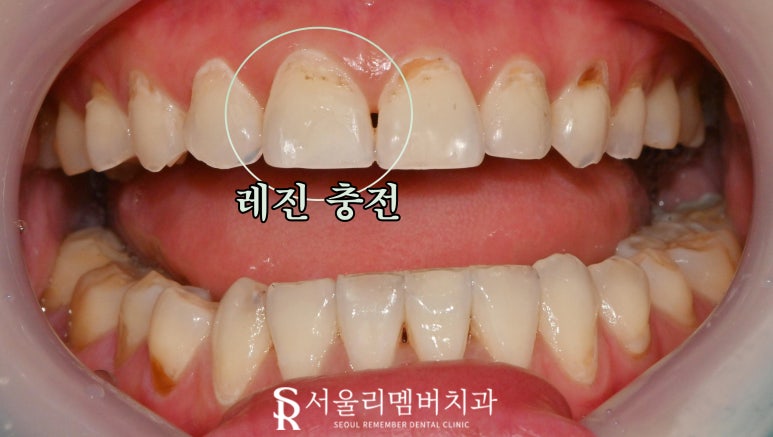 신대방 치과 앞니 끝(절단연) 약간 깨짐? 전치부 파절 레진 당일 치료 및 주의 사항 관련 이미지 4