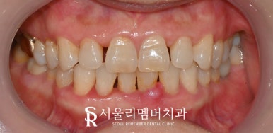 Restore a Natural, Even Smile with No-Prep Realnate! Laminate Veneers for Front Teeth at a Seoul National University Entrance Station Dental Clinic image 5