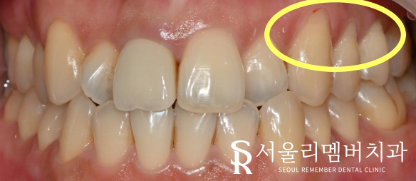 봉천역 치과 에서 레진 당일 치료로 치경부마모증(CA)를 개선해드렸습니다. 관련 이미지 4