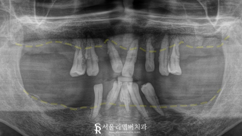 상도동 치과 위아래 다수의 치아 상실, 원가이드를 이용한 디지털 임플란트 로 상하악 전체 재건 가능 관련 이미지 3