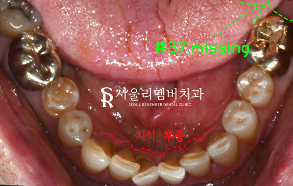 봉천동 치과 임플란트 치료 과정, 어금니가 없어서 식사가 어려워요. 관련 이미지 2