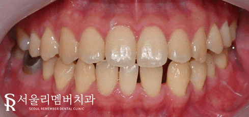 은천동 치과 치아 사이 벌어짐, 당일 치료 가능할까요? 관련 이미지 2