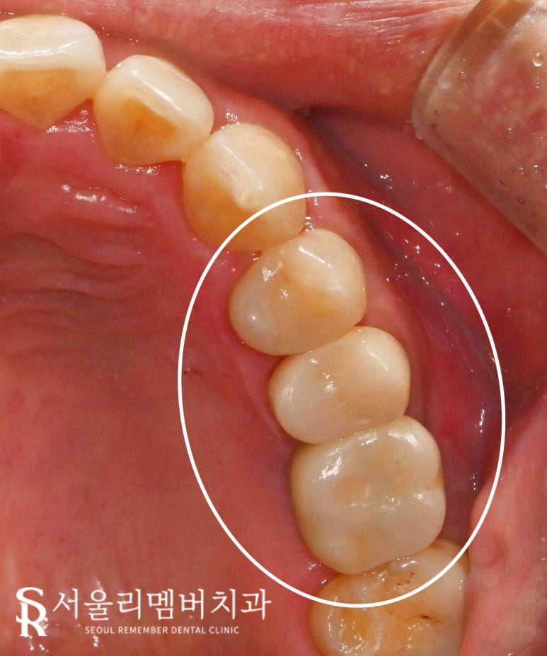 서울대입구 치과 치아 파절로 인한 신경치료 크라운 및 씹을때 통증으로 발치 후 임플란트 관련 이미지 3
