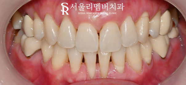 "이가 누렇고 패어있어요." 신림 치과 에서 치경부 마모증 레진 치료와 치아 미백으로 개선한 증례 관련 이미지 4