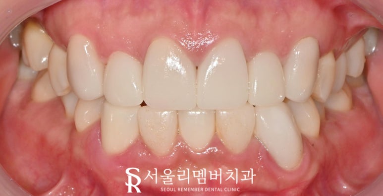 Nakseongdae Dental Clinic: If a front tooth laminate veneer falls off, can’t it just be reattached? Anterior crowns and Realnate re-prosthetics image 4