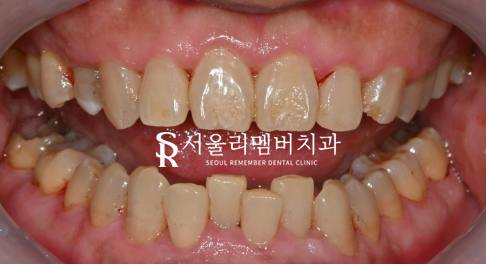 서울대입구역 치과 에서 알려드리는 스케일링의 모든 것-! 관련 이미지 3