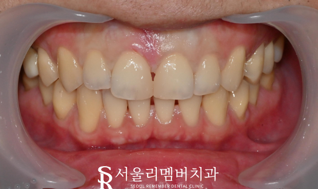 중요한 일 앞두고 앞니가 벌어졌어요. 신대방 치과 에서 레진으로 티 안나게 성형(feat. 다이아스테마) 관련 이미지 2