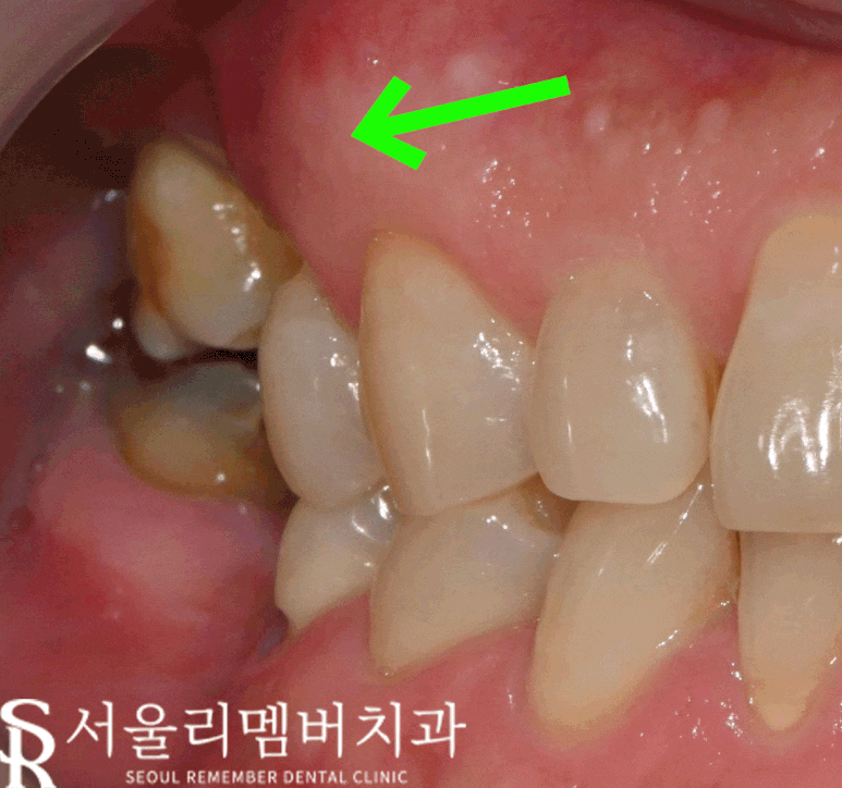 "이제 밥 먹는 것도 문제없어요!" 낙성대 치과 임플란트 로 새로운 구강 환경 찾아 드린 사례 관련 이미지 8