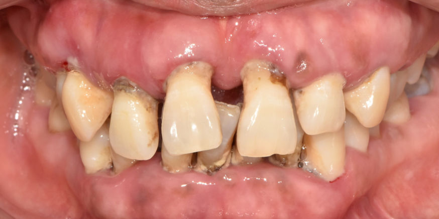 밝게 웃어본 적이 언젠지.. 낙성대역 서울 리멤버 치과 에서 잃어버린 미소를 찾아드렸습니다. 관련 이미지 4