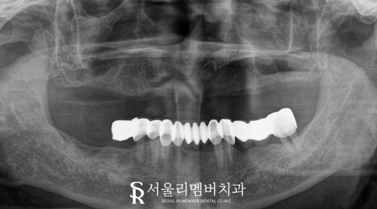 서울대입구역 치과 대표원장이 직접 봐드리는 무치악 환자 전체 임플란트 치료 케이스 관련 이미지 3