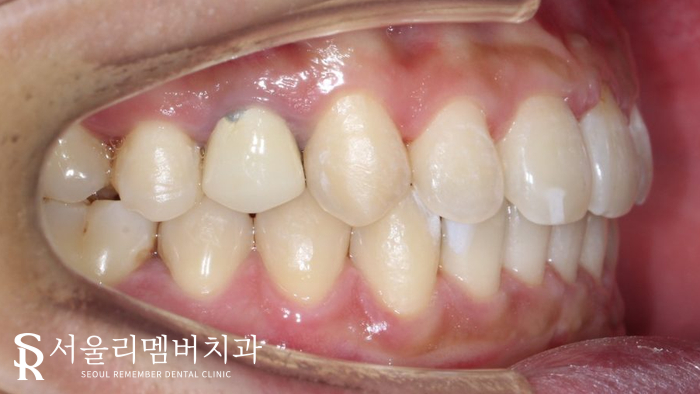 벌어진 치아, 사당 치과 인비절라인으로 개선할 수 있을까? 관련 이미지 9