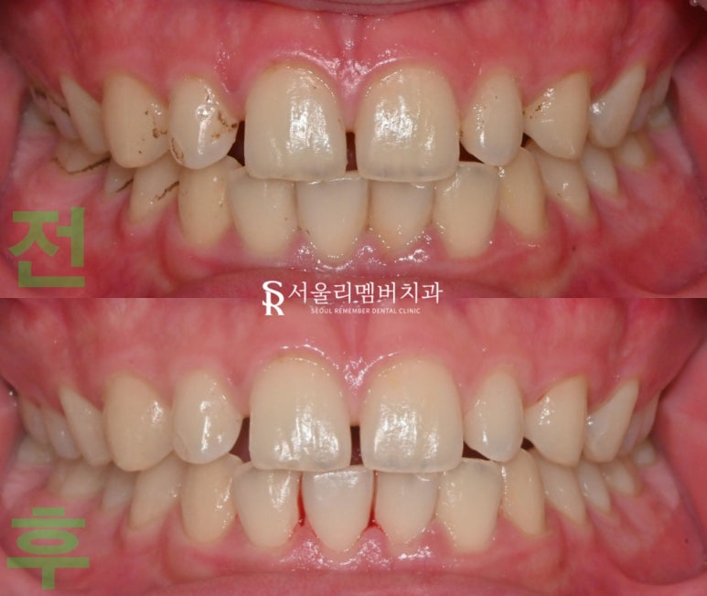 낙성대역 치과 에서 알려주는 스케일링 중요성 관련 이미지 3