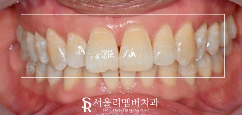 앞니 탈회 초기 충치 절단연 깨짐 치아 길이 안맞음 서울대입구 치과 전치부 리얼네이트 치료 과정 관련 이미지 1