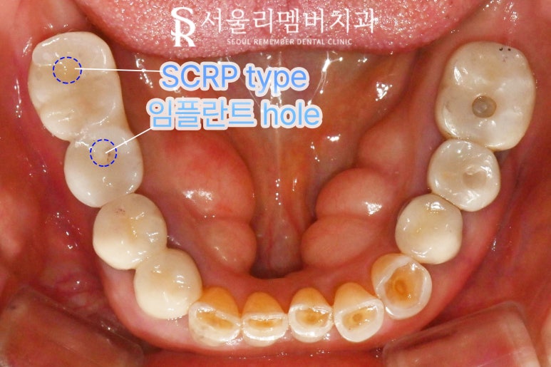 사당역 치과 임플란트 주위 염증으로 픽스처 제거 후 다시 식립 재수술 필요하다면? 관련 이미지 5