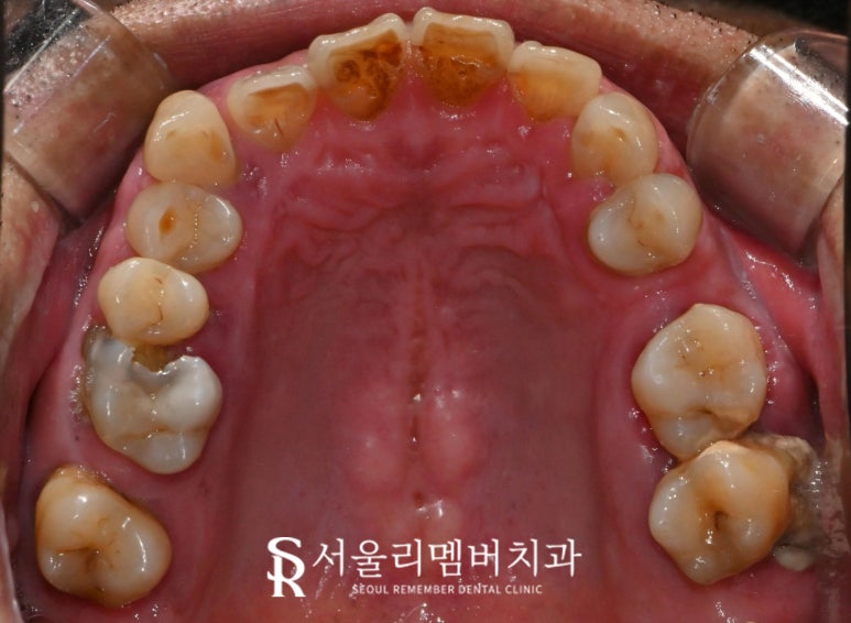 무너진 구강 환경 서울대입구역 치과 에서 편하게 전체 임플란트 치료한 사례 관련 이미지 3