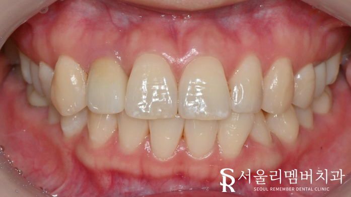 어? 전에 올려놨던 앞니 크라운이 갑자기 떨어졌어요 ! 신길동 치과 관련 이미지 4