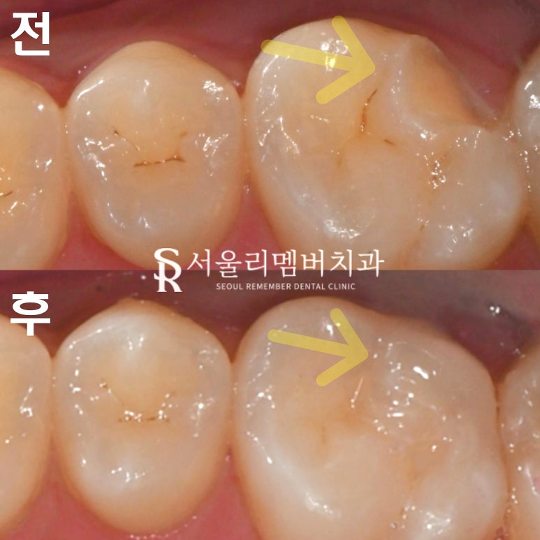 봉천역 치과 어금니 깨짐 당일 레진 치료 되는 곳, 자연스러운 외관 회복 관련 이미지 4