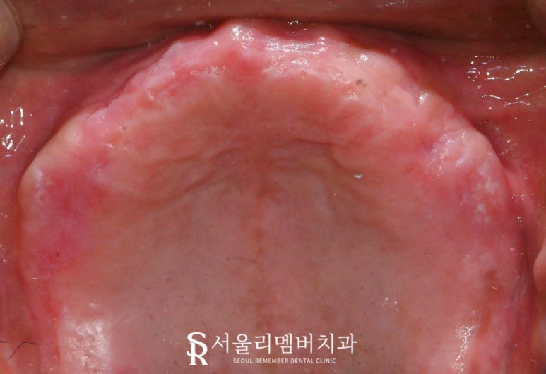 서울대입구역 치과 치아가 하나도 없는 무치악 환자를 위한 최소 비용 풀아치 임플란트 관련 이미지 3
