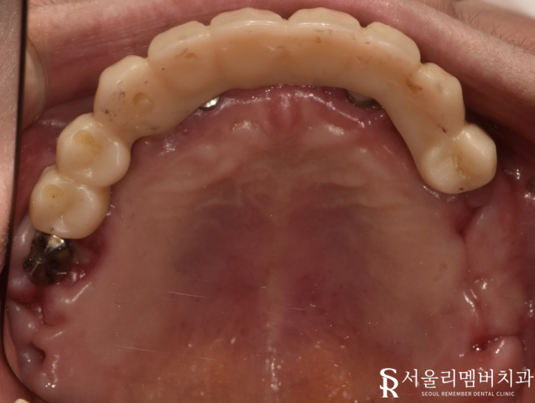 빠져버린 치아 그대로 내버려 두면 안모변형을 초래할 수 있습니다! 신림역 서울 리멤버 치과 관련 이미지 6