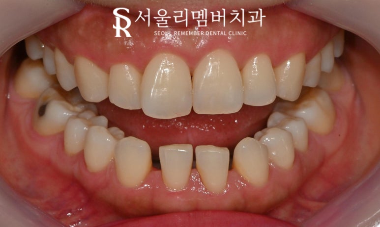 낙성대 치과 앞니 틀어짐 하악 전치 측절치 결손 라미네이트로 공간 닫기 성공 관련 이미지 5