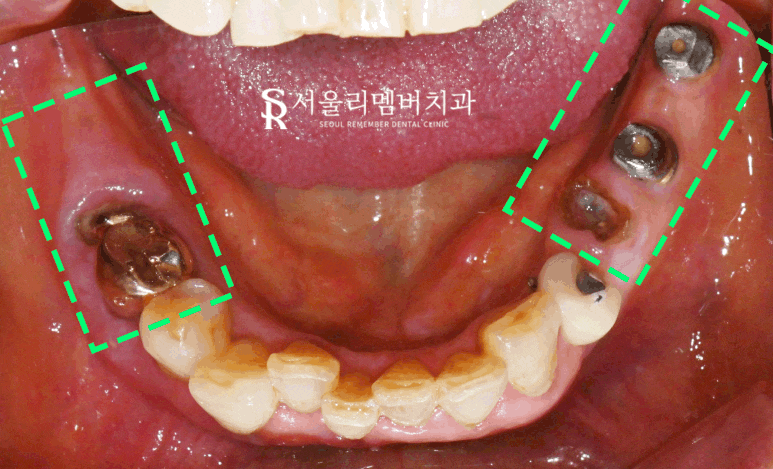 봉천동 치과 상실된 치아 방치하면 안 되는 이유 (feat.임플란트 브릿지 보철치료) 관련 이미지 3