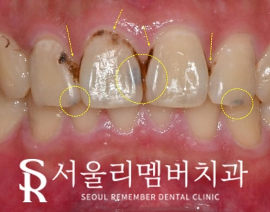 앞니 충치, 서울대입구역 치과 에서 당일 레진 치료로 빠르게 환한 웃음 되찾으세요! 관련 이미지 2