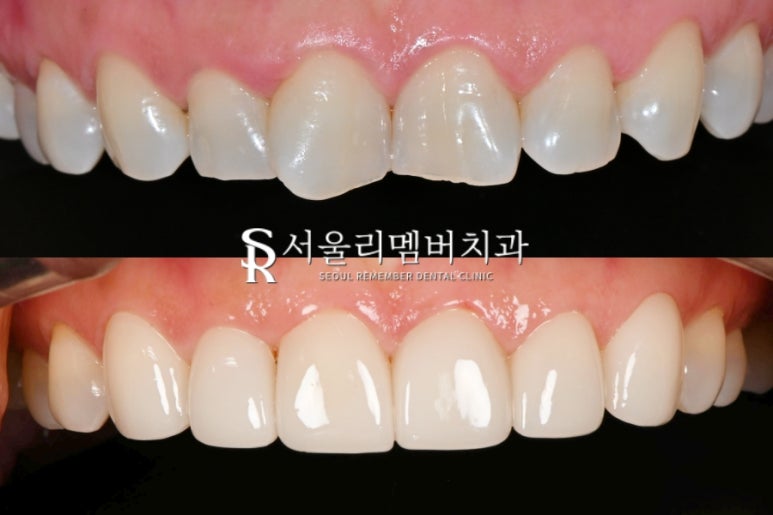 사당 치과 틀어지고 뻐드러진 앞니, 송곳니까지 리얼네이트 치료로 자연스러운 전치부 균형 찾기 관련 이미지 5