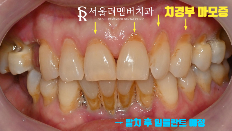 사러가사거리 치과 잇몸이 패이는 치경부 마모증, 어떻게 개선할 수 있을까? 관련 이미지 2