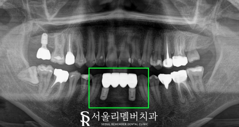 아래 앞니 부러짐 뿌리 끝 염증 봉천동 치과 하악 4전치 발치 후 오스템 임플란트 관련 이미지 5