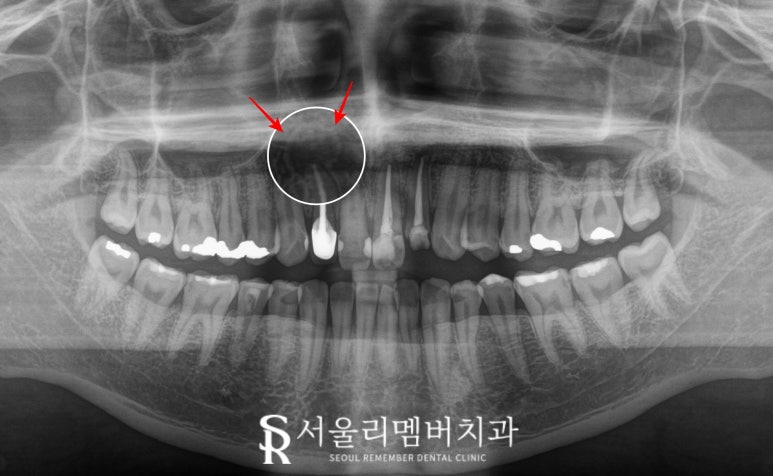 앞니 뿌리 끝 염증, 치근단 절제술(apicoectomy) 보라매 치과 관련 이미지 2