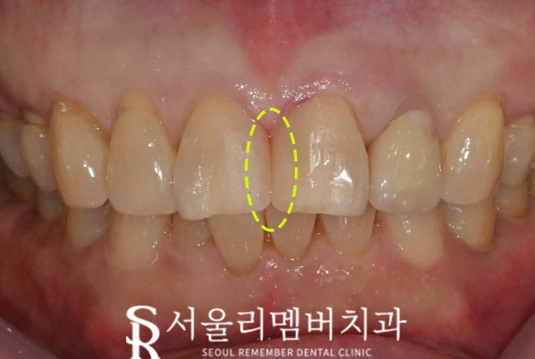 서울대입구역 치과, 벌어진 치아를 당일에 치료하는 방법. 정중이개 레진 수복 관련 이미지 2