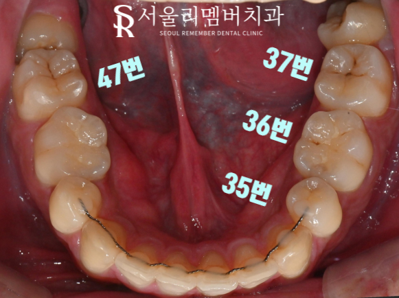 서울대입구치과 상황에 맞는 단계별 충치치료로 구강 고민 해결 완료! 관련 이미지 1