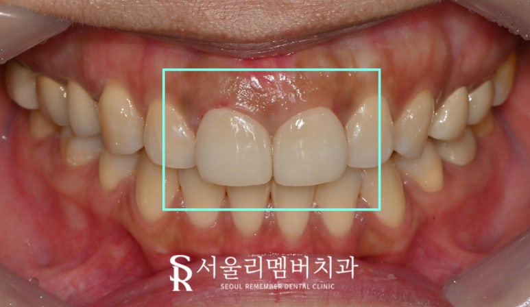 벌어진 앞니 사이 간격 고민이라면 교정? no 라미네이트? yes 서울대입구역치과 관련 이미지 3