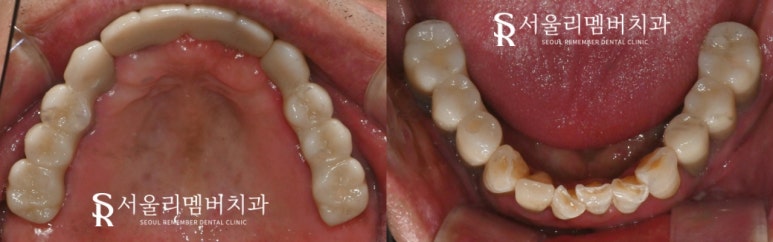 사당 치과, 틀니 대신 전체 임플란트로 새로운 구강 환경 되찾아 드린 사례 관련 이미지 5
