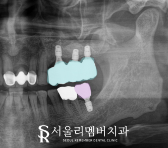 봉천동 치과 임플란트 치료 과정, 어금니가 없어서 식사가 어려워요. 관련 이미지 7