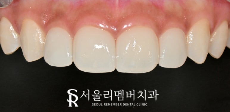 앞니 벌어짐, 레진 말고 라미네이트로 사이 틈새 자연스럽게 채우자 서울대입구 치과 상악 전치부 리얼네이트 케이스 관련 이미지 7