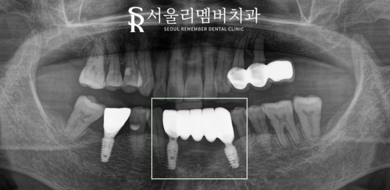 Loose Lower Front Teeth, Sillim Station Dental Clinic, Insurance Anssurge Implant for Patients 65 and Older, Minimal Placement, Lower Cost, Faster Completion image 8